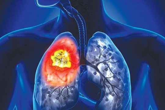 Hút thuốc lá gây nhiều bệnh về phổi