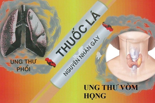 Thuốc lá - tác nhân gây nên ung thư vòm mũi họng