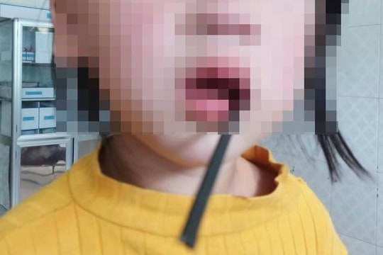 Bé gái 4 tuổi bị thanh sắt đâm xuyên miệng trong lúc vui đùa