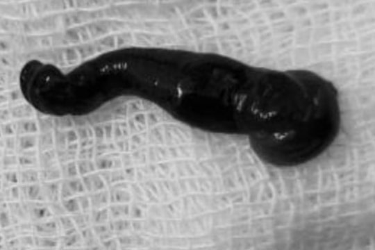 Cận cảnh gắp con đỉa rừng chui sâu trong hốc mũi cháu bé người Mông