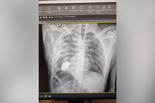 Bác sĩ mổ lấy quả lựu đạn chưa phát nổ trong lồng ngực binh sĩ Ukraine