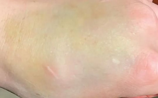 Vết bầm tưởng vô hại trên tay là dấu hiệu ung thư