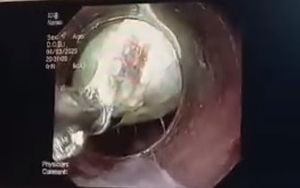 Sản phụ ở Nghệ An suýt mất mạng vì nuốt túi mật lợn để chữa đau bụng