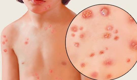 5 món ăn thuốc bổ dưỡng, chăm sóc trẻ bị thủy đậu