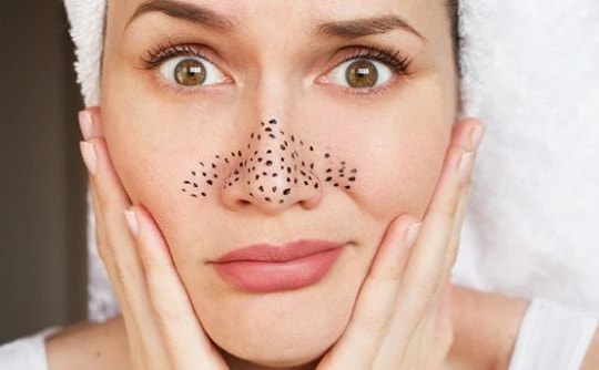 6 cách đơn giản 'đánh bay' mụn đầu đen nàng nên biết