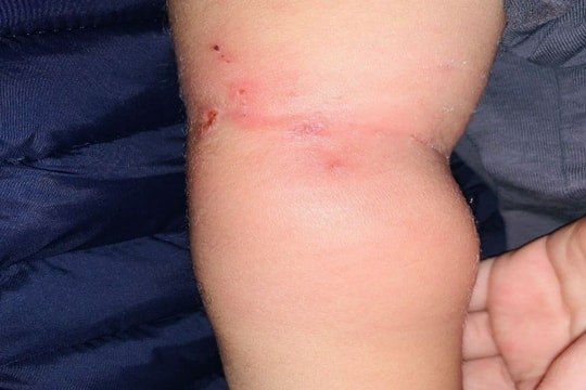 Trẻ bị nhiễm khuẩn huyết từ vết muỗi đốt 