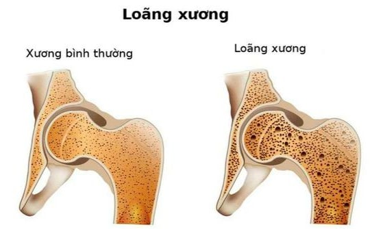 Loãng xương: 8 nhóm yếu tố nguy cơ bạn cần biết