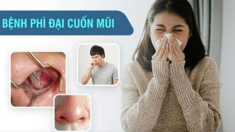 Ngạt mũi liên tục gây khó thở, khó ngủ: nguyên nhân và cách điều trị
