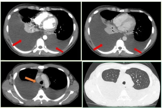 Phát hiện mắc hai bệnh ung thư từ dấu hiệu mờ nhạt