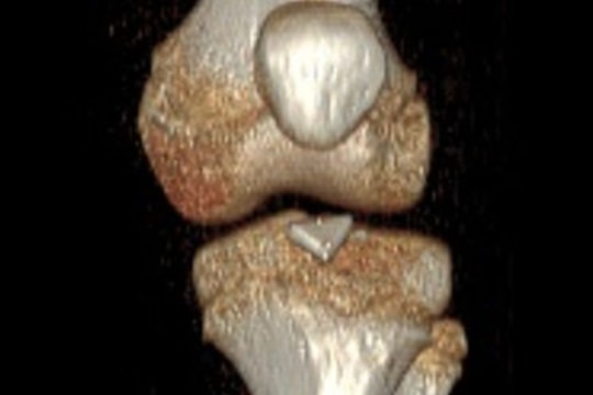 Phẫu thuật lấy mảnh sành sắc nhọn 'nằm yên' 2 năm trong khớp gối của trẻ