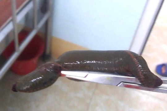 Gắp con đỉa chui vào dương vật cụ ông 71 tuổi 