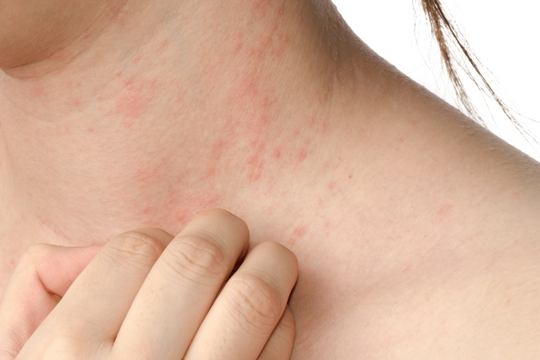 Mùa hè cảnh giác với sẩn ngứa do côn trùng