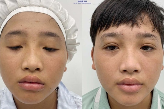 Trả lại đôi mắt tự nhiên cho cậu bé 14 tuổi bị sụp mí bẩm sinh