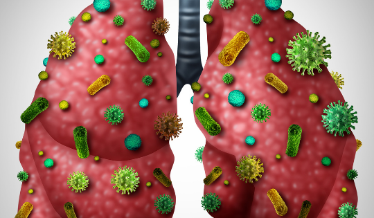 Viêm phổi không điển hình do vi khuẩn ở trẻ