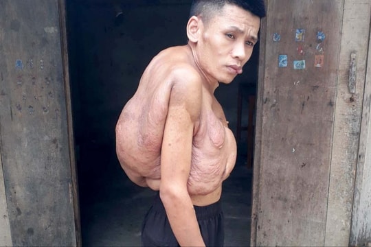 Chàng trai đáng thương 'cõng' khối u 'khổng lồ' suốt hơn 20 năm