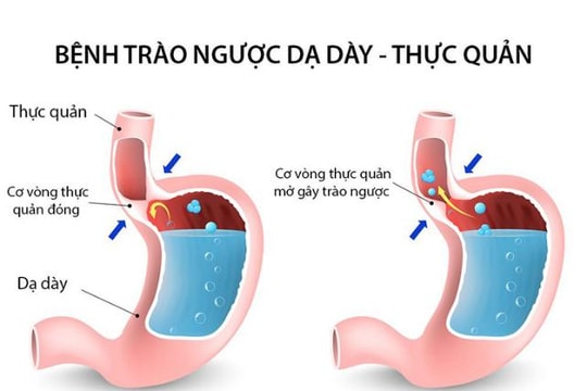 Trị trào ngược dạ dày thực quản bằng thuốc đông y