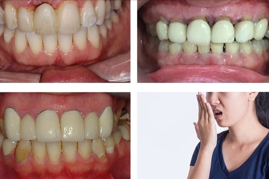 Sự thật về những biến chứng khi bọc răng sứ 