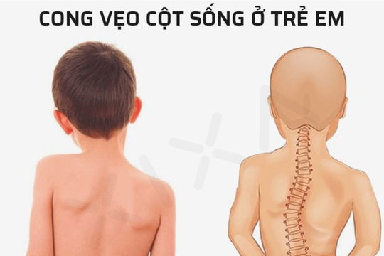 Vẹo cột sống ở trẻ nguyên nhân, biểu hiện và các biện pháp phòng ngừa