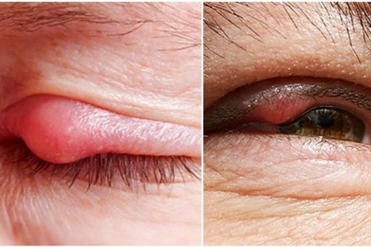 Sưng mí mắt kèm đau nhức mắt là bệnh gì?