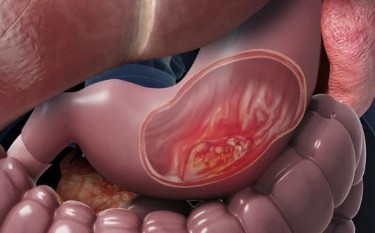 Đau bụng âm ỉ thượng vị, 1 trong 5 dấu hiệu của ung thư dạ dày cần cảnh giác