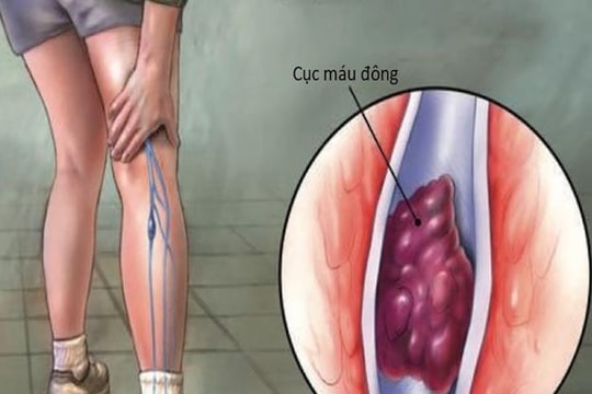 Phòng huyết khối tĩnh mạch sâu nhờ 7 bước đơn giản ai cũng có thể thực hiện