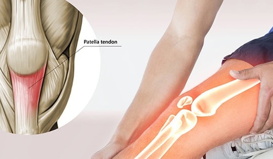 Viêm gân bánh chè tập thế nào để nhanh hồi phục?