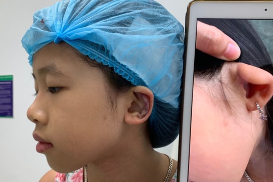 Bé gái 8 tuổi được tạo hình tai thành công tại Bệnh viện Chấn thương - Chỉnh hình Nghệ An