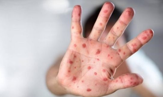 Bộ Y tế nói gì về thông tin thiếu thuốc điều trị tay chân miệng?