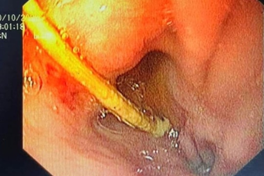 Gắp thành công tăm tre dài 5cm trong dạ dày bệnh nhân