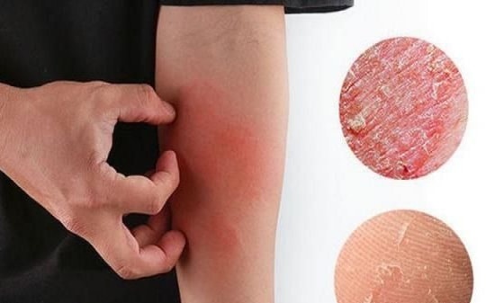 4 bài thuốc bổ huyết phòng ngừa da khô mùa đông