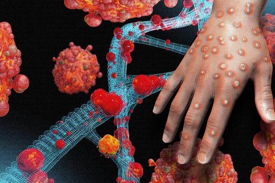 Bệnh đậu mùa khỉ và những nguy cơ cao với người có HIV