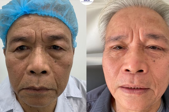 Địa chỉ điều trị sụp mí an toàn, hiệu quả cho người cao tuổi ở Nghệ An 