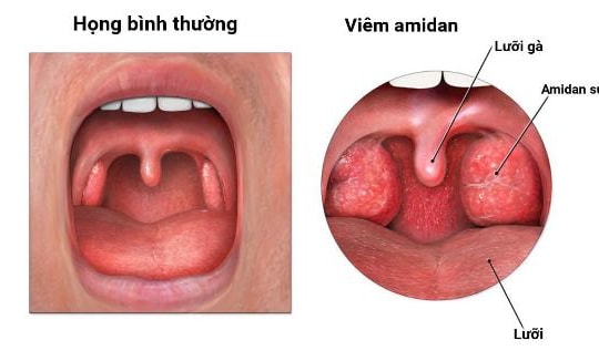 Xoa bóp huyệt vị hỗ trợ điều trị viêm họng