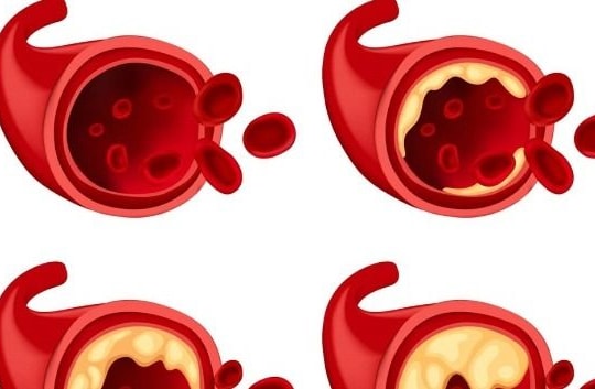 Nguy cơ gia tăng bệnh tim mạch trong mùa lạnh và cách phòng tránh