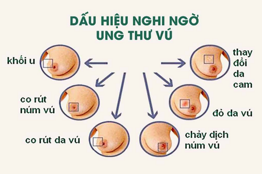 10 biện pháp giúp giảm nguy cơ ung thư vú