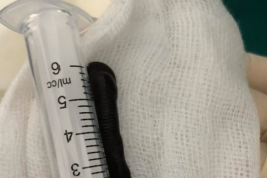 Phát hiện con đỉa còn sống trong khí quản của bệnh nhân