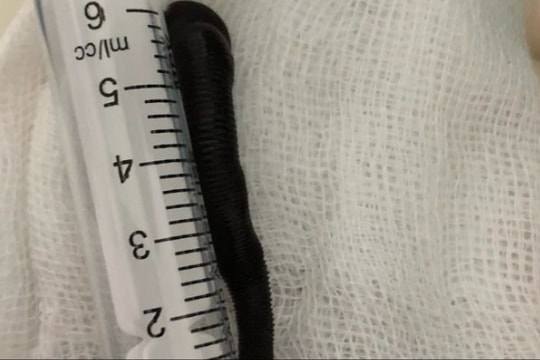 Gắp con đỉa dài hơn 6 cm ra khỏi khí quản bệnh nhân
