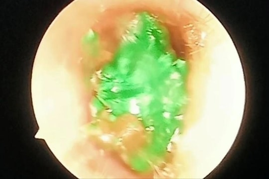 Gắp thành công dị vật là đất sét trong tai trẻ nhỏ