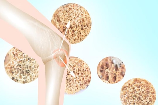 5 lời khuyên giữ xương chắc khỏe khi bước sang tuổi 40