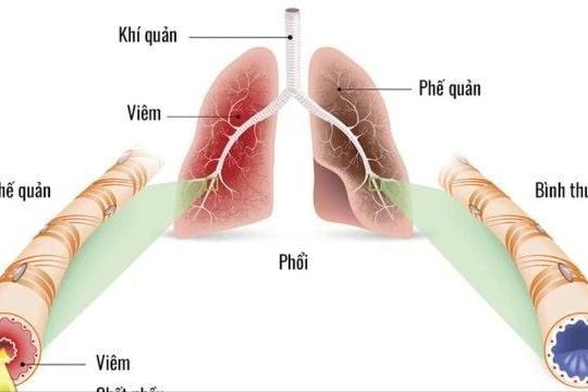 Viêm phế quản cấp bao lâu thì khỏi?