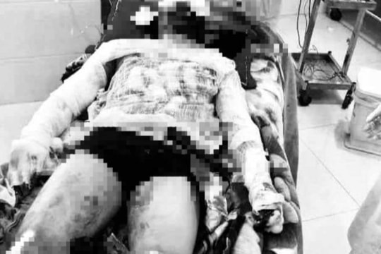 Nam thanh niên ở Diễn Châu bị bỏng nặng vì pháo tự chế