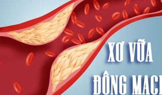 Cách giúp phòng xơ vữa động mạch, ngăn ngừa đột quỵ