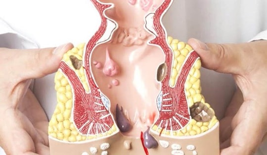 Bệnh trĩ có tự khỏi không, cần làm gì khi mắc trĩ?