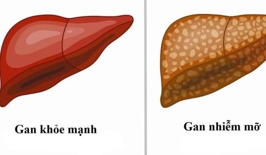 Gan nhiễm mỡ: Nguyên nhân, biểu hiện, điều trị và phòng bệnh