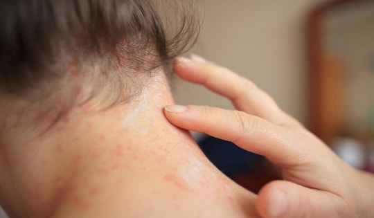 Biện pháp tại nhà phòng và trị rôm sảy