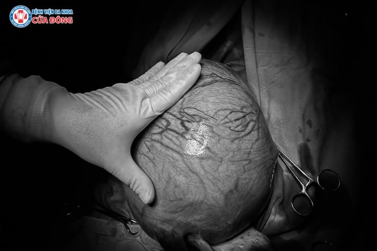 Cắt khối u xơ tử cung kích thước ‘khủng’, nặng 4kg cho bệnh nhân Lào