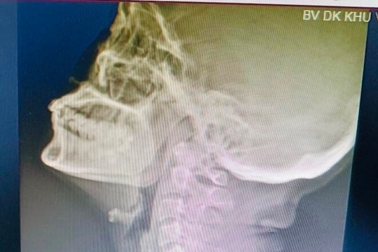 Gắp thành công viên thuốc nguyên bao phim trong thực quản bệnh nhân