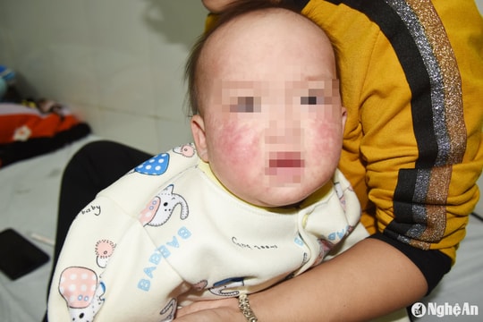 6 tháng đầu năm, Nghệ An phát hiện 45 ca mắc sởi