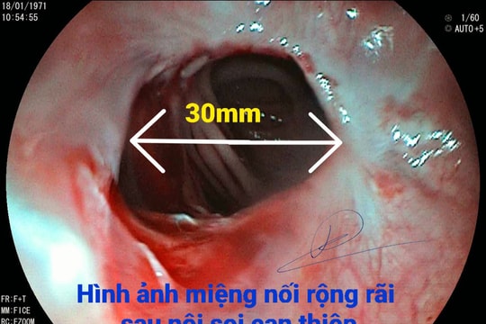 Bệnh viện Hữu nghị Đa khoa Nghệ An: Nội soi nong bóng Plastic Rigiflex điều trị hẹp miệng nối sau mổ cho bệnh nhân