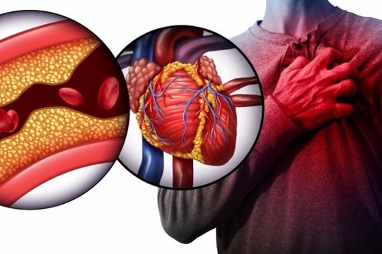 Dấu hiệu cảnh báo nhồi máu cơ tim ai cũng cần biết